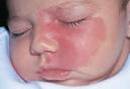 face of infant with birthmark