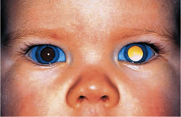 eyes of infant with eye abnormality 