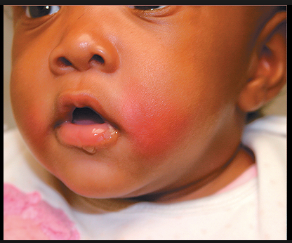 infant with swollen cheek