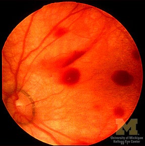 Retinal hemorrhages seen in trauma such as child abuse or shaken baby