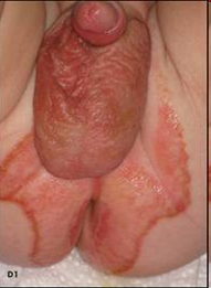 infant with rash
