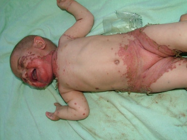 infant with rash